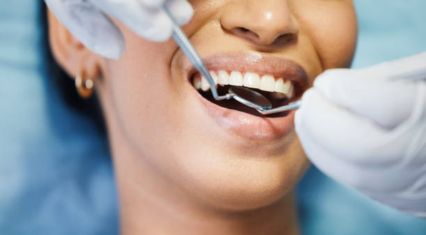 Best Knocked-Out Tooth (Avulsed Tooth) Treatment in Gloversville, NY